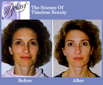 Before and After pictures of a Belavi Facial Massage